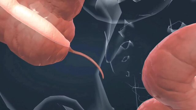 Causes and symptoms of appendix