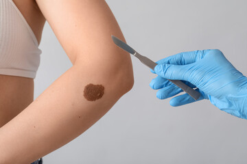 Surgeon with scalpel and birthmark on woman's arm against light background, closeup