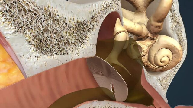 Ruptured eardrum