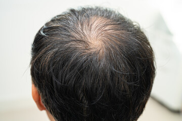 Fototapeta premium Bald in the middle head and begin no loss hair glabrous of mature Asian business smart active office man.