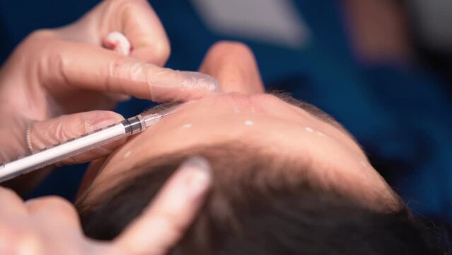 Beautician doctor makes botox injection in the forehead of young beautiful woman. Extreme close up 4k shot