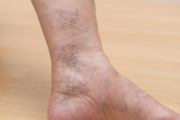 Health care beauty, varicose veins on skin of leg, woman showing vascular, thrombosis on legs...