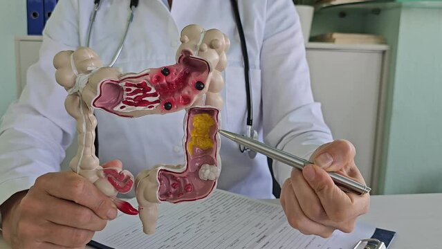 Intestine doctor holding an anatomical model for diagnosis and treatment in hospital. Intestinal diseases ulcers and gastritis