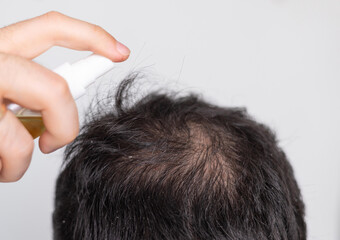 man with bald on head using oil spray, derma roller with needles for hair growth stimulation. guy...