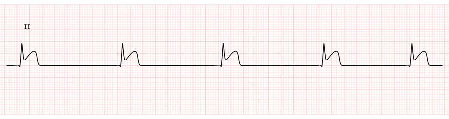 EKG Monitor in lead II Showing  junctional Bradycardia with STEMI at Inferior Wall