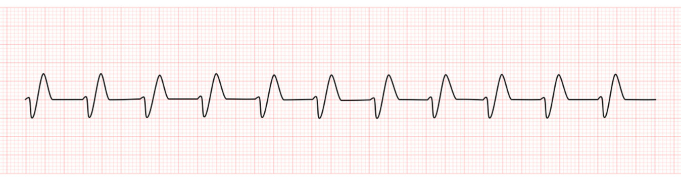 EKG Monitor Showing Wide QRS Complex From Hyperkalemia