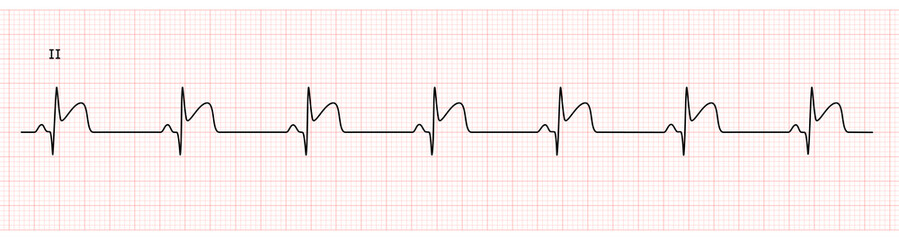 EKG Monitor in lead II Showing  Sinus Rhythm with Late STEMI at Inferior Wall with Deep Q Wave