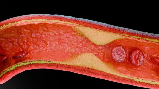 Cholesterrol or Atherosclerotic Plaque in blood vessels, Blocked vessel stroke, Thickened Arteries and Veins, Coronary, fat buildup clogging, Atherosclerosis or atheromatous Hyperlipidemia, 3d render