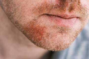 A close-up of a man's face with visible stubble and redness caused by seborrheic dermatitis, showing skin irritation and flaky patches.