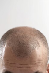 Fototapeta premium Close up of a person with a bald head, suitable for medical or skincare concepts