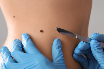 Surgeon with scalpel and mole on woman's belly against light background, closeup