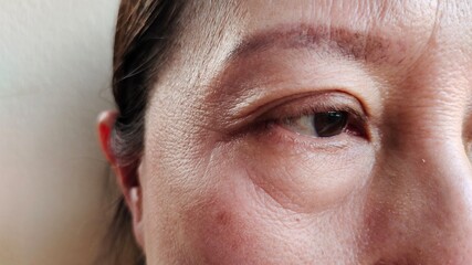 close up the wrinkle and Flabby skin beside the eyelid, dark spots and blemish, dullness and loose...