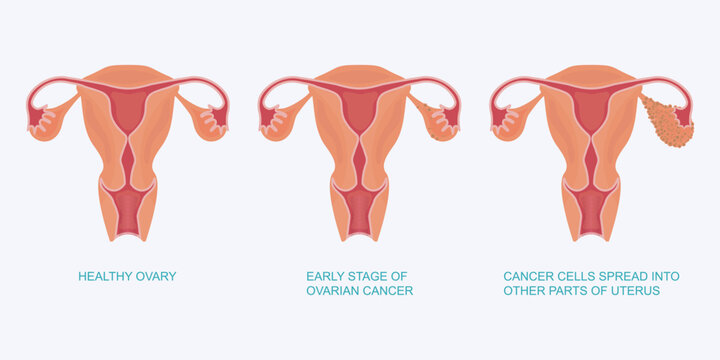 Stage of ovarian cancer.