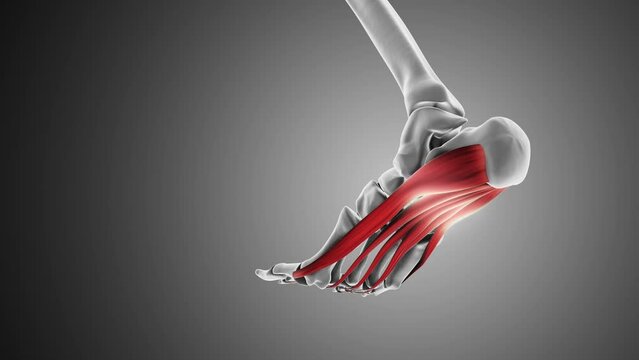 Plantar fascia dysfunction medical animation