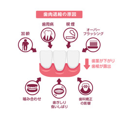 歯肉退縮（歯茎の下がり）の原因 ベクターイラスト