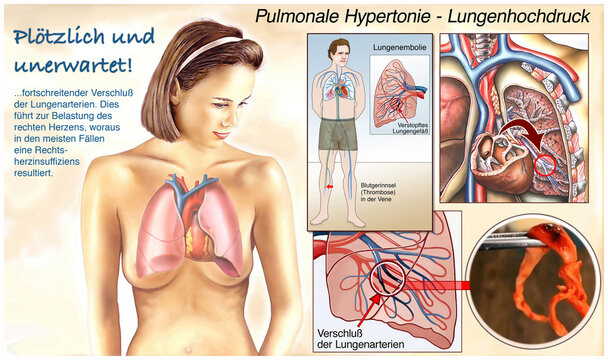 Pulmonale Hypertonie.Lungenhochdruck.Embolie