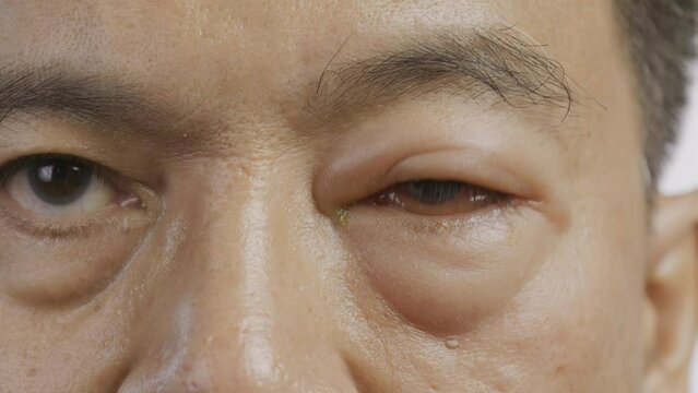 Senior man with swollen eye from insect bite on white background.
