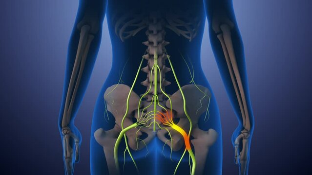 Sciatica nerve pain lower back through hips to leg