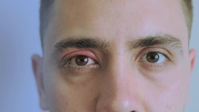 Close-up of an infected eye, showing redness. Eye condition covered by medical insurance, including treatment for eye infections and regular eye check-ups by an ophthalmologist.
