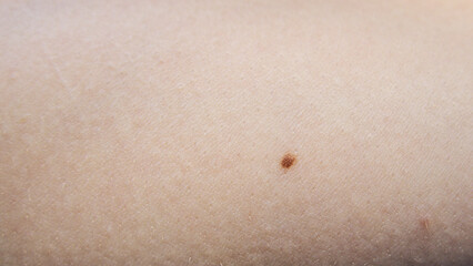 Small little brown rounded circle birthmark