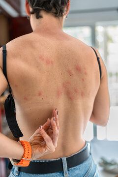 Woman Suffering From Bed Bug Bites in Africa