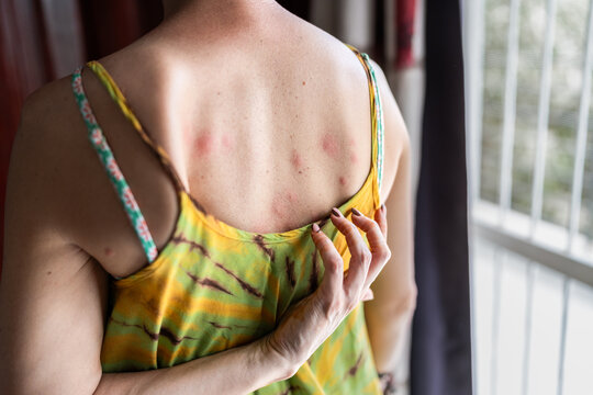 Woman Suffering From Bed Bug Bites in Africa