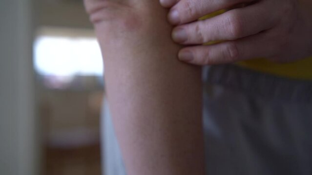 A woman itches a bite in the elbow area, bug bite. Young woman scratching arm from having itching.