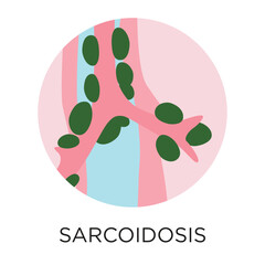 Sarcoidosis flat style vector illustration in circle layout with type, medical infographic