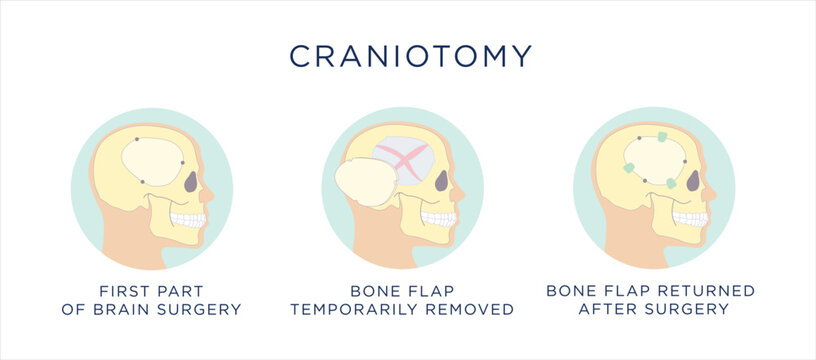 Craniotomy vector illustration showing step by step surgical procedure