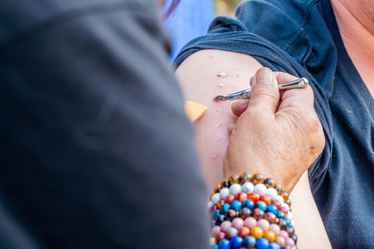Kambo Ceremony: Marks on the Arm