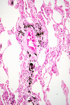 Diffuse pulmonary emphysema human cells