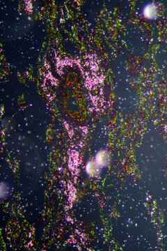 Diffuse pulmonary emphysema human cells