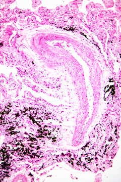 Diffuse pulmonary emphysema human cells