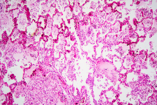 Micrograph of lobar pneumonia haemorrhagic edema period