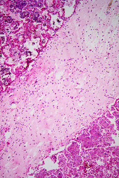 Micrograph of lobar pneumonia haemorrhagic edema period