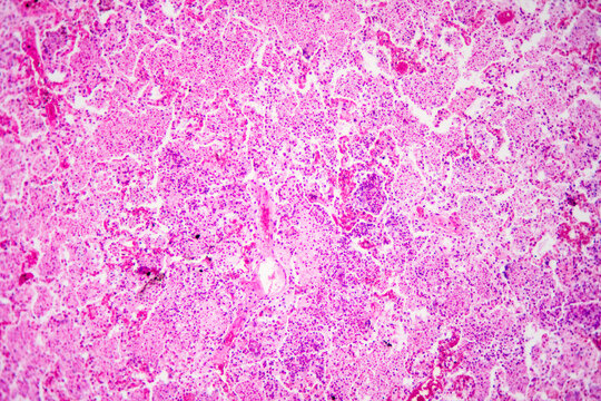 Micrograph of lobar pneumonia haemorrhagic edema period