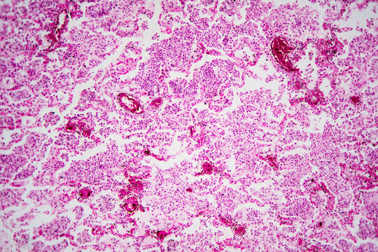 Micrograph of lobar pneumonia haemorrhagic edema period