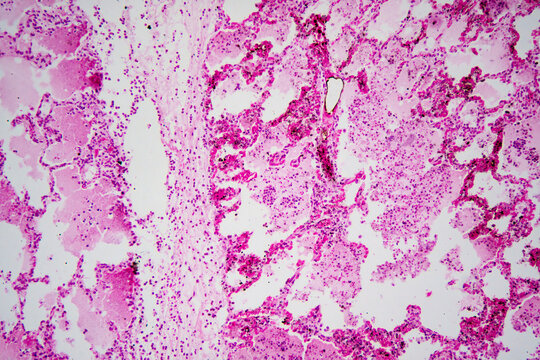 Micrograph of lobar pneumonia haemorrhagic edema period