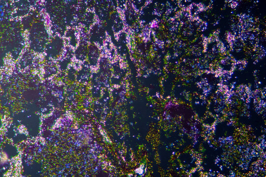 Micrograph of lobar pneumonia haemorrhagic edema period