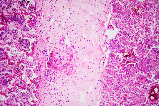 Micrograph of lobar pneumonia haemorrhagic edema period