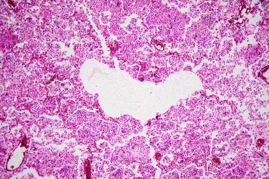 Micrograph of lobar pneumonia haemorrhagic edema period