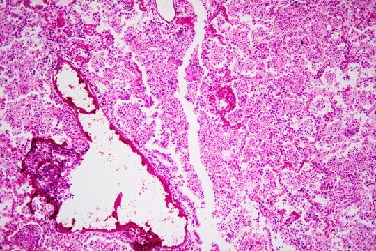 Micrograph of lobar pneumonia haemorrhagic edema period