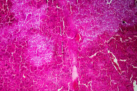 Micrograph of lobar pneumonia red hepatization stage