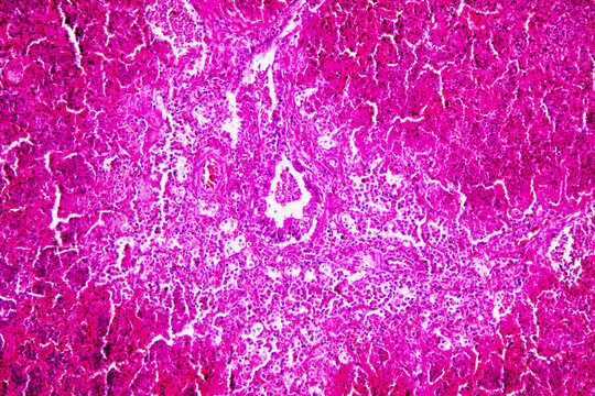 Micrograph of lobar pneumonia red hepatization stage