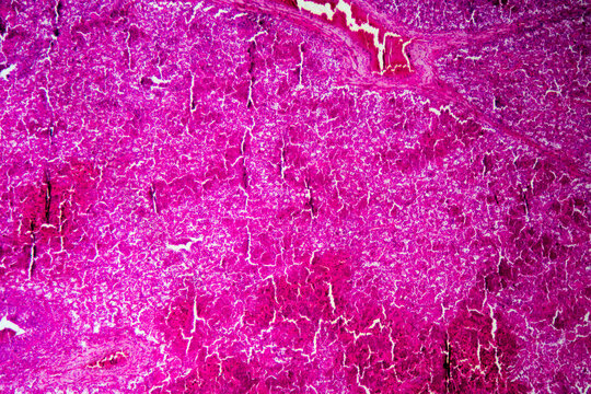 Micrograph of lobar pneumonia red hepatization stage