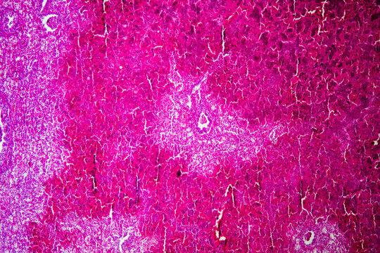 Micrograph of lobar pneumonia red hepatization stage