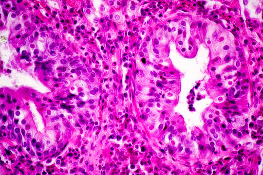 Micrograph of lobar pneumonia red hepatization stage