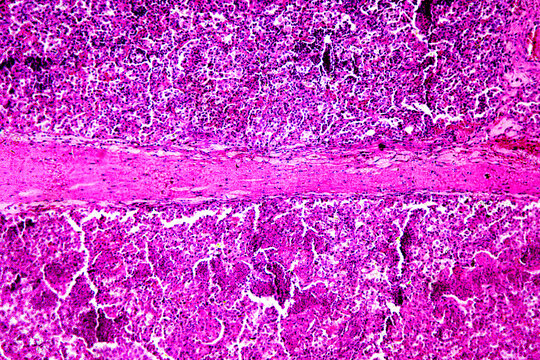 Micrograph of lobar pneumonia red hepatization stage