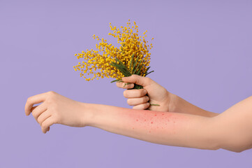 Young woman with skin allergy and mimosa on purple background