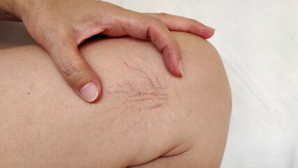 Portrait the hand holding the flabbiness and wrinkle, problem varicose veins, circulation blood and...